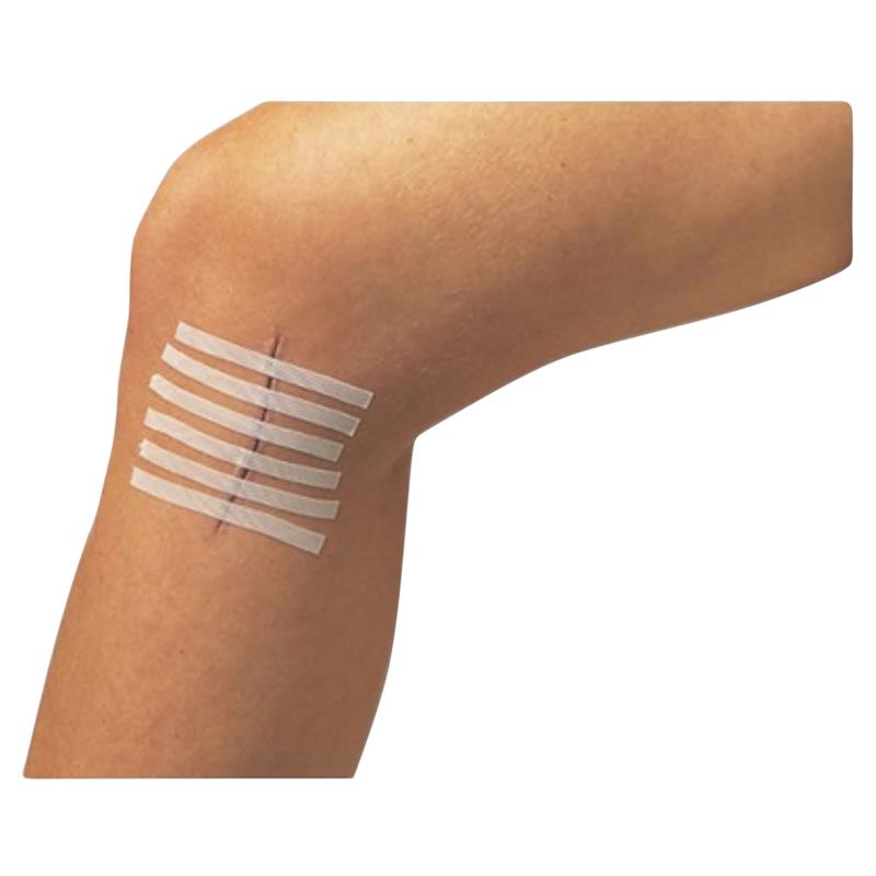 Leukostrip Wound Closure Strips 6.4mm x 76mm - Secure and Reliable Closure-Auzzi Store