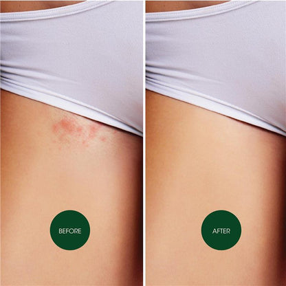 Nad's Soothing Ingrown Hair Solution with Aloe & Green Tea - 125ml