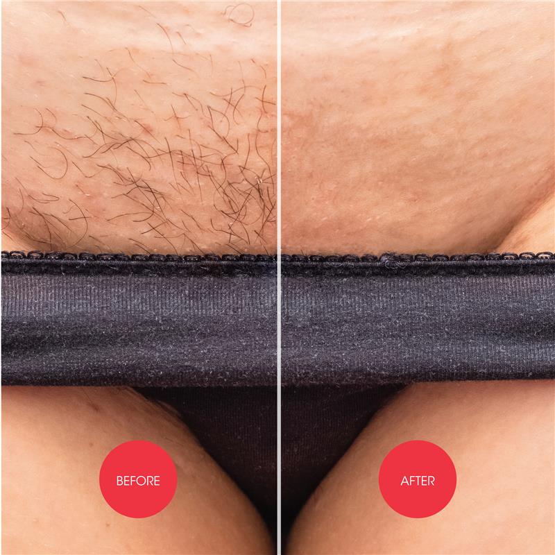 Nads Down Under Hair Removal Cream - 150ml for Gentle Hair Removal