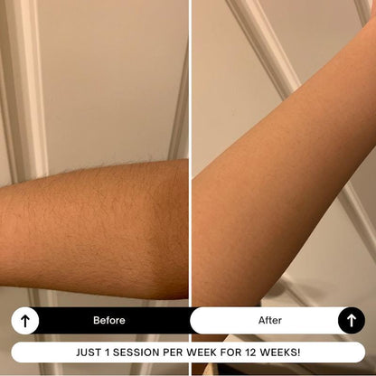 Happy Skin Co Gen.2 IPL Hair Removal Handset – White