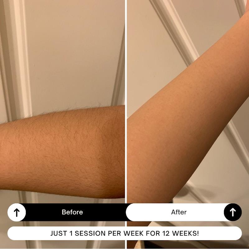 Happy Skin Co On The Go Gen.2 IPL Hair Removal Bundle - White