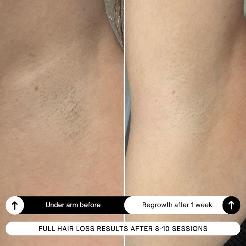 Happy Skin Co On The Go Diamond IPL Hair Removal Bundle